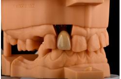 China Internal Hex 3.0mm Depth 1.5mm Pitch Single Titanium Tooth Implant Replacement supplier