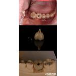4-6 Dental Endosseous Tapered Implant Subcrestal Bone Level And Internal Hex Connection for sale