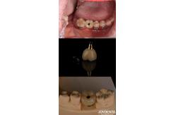 China 4-6 Dental Endosseous Tapered Implant Subcrestal Bone Level And Internal Hex Connection supplier