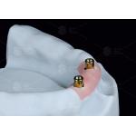 Overdenture Locator Attachments Titanium Bracket Locator Denture Attachments for sale