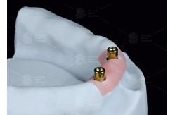 China Overdenture Locator Attachments Titanium Bracket Locator Denture Attachments supplier