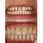 Long-lasting Dental Veneers No Discoloration Perfect For B2B Sourcing Needs And More for sale