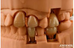 China Customizable Implant Crown and Bridge Achieve a Natural Look with Long-lasting Results supplier