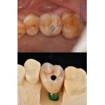 Titanium Full Arch Dental Implants Prosthetic Platform 4.1mm For Exceptional Durability for sale