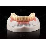 Composite Pink Porcelain Crown A1 Shade All On 4 Hybrid Titanium Screw Retained