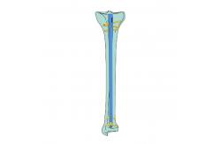 China 8/9/10 Mm Thickness Titanium Intramedullary Nail System Proximal Tibial Interlocking Nail supplier