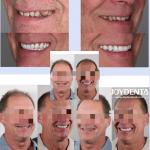 Zirconia dentures that imitate natural teeth for sale