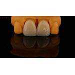 5 Year Guarantee Full Contour Zirconia Crown Customized Vita Shade High Aesthetic Natural Dental Bridge for sale