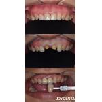 Biologically Oriented Preparation Technique Dental vertical Preparation Minimally Invasive for sale