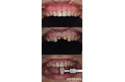 China Biologically Oriented Preparation Technique Dental vertical Preparation Minimally Invasive supplier