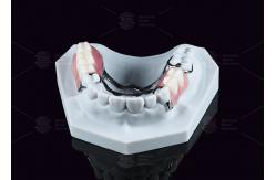 China Removable Metal Acrylic Partial Denture With Clasps For Partial Chewing supplier