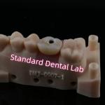 Custom Abutment Implant Crown Full Contour Zirconia Screw Retained for sale
