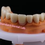 Digital CAD CAM Milling Layered Zirconia Bridge Crown With Pink Porcelain for sale