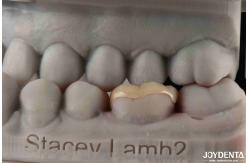 China Customizable Zirconia Inlay Onlay Minimal Preparation For Damaged Teeth Restoration supplier