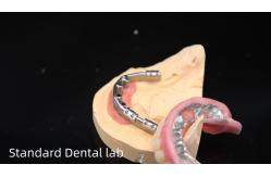 China Titanium Implant Supported Dentures Precise Ivoclar Denture Over Implants supplier