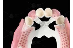 China Biocompatibility Dental Telescope White Inner Zirconia Outer Peek Telescope Dental supplier