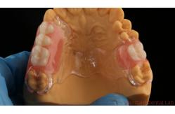 China Flexible Clear Metal Cast Framework Partial Dentures High Esthetics Perfect Fit supplier