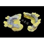 Custom Cast Partial Denture Natural Looking Solution For Enhanced Comfort And Speech for sale