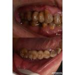 Rough Surface Design Dental Implant for Subcrestal Bone Level Titanium Material for sale