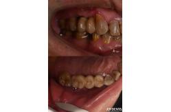 China Rough Surface Design Dental Implant for Subcrestal Bone Level Titanium Material supplier