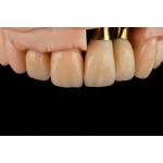 Titanium Sandblasted Single Tooth Replacement Implant With Gamma Irradiation Sterilization for sale