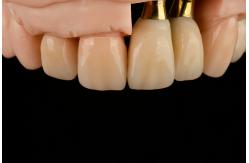 China Titanium Sandblasted Single Tooth Replacement Implant With Gamma Irradiation Sterilization supplier