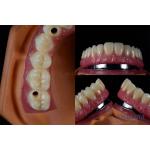Titanium Multiple Dental Implants Teeth Internal Implants Cracking Resistant Customized for sale