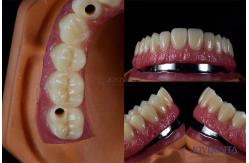 China Titanium Multiple Dental Implants Teeth Internal Implants Cracking Resistant Customized supplier