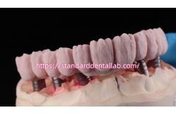 China Implant Supported Zirconia Bridge With Titanium Abutment High Esthetics supplier