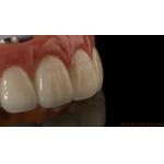 Professional Zirconia Dental Implant Crown Titanium CAD CAM Zirconia Crown China Dental Lab for sale