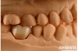 China Natural-looking Multilayer Full Zirconia For High Strength And Durability supplier