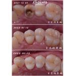 Accurate Fit Dental Porcelain Inlay Damaged Teeth Restoration For Adults And Children for sale
