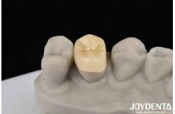 China Secure Cementation Emax Inlay Onlay Easy To Clean And Resistant To Staining supplier