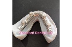 China Cast Cobalt Chrome Metal Framework Partial Denture With Metal Frame supplier