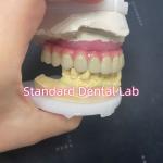 Malo Bridge Hybrid Zirconia All On Four / Six Zirconia Implant Bridge TItanium Bar