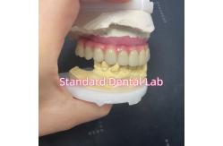 China Malo Bridge Hybrid Zirconia All On Four / Six Zirconia Implant Bridge TItanium Bar supplier