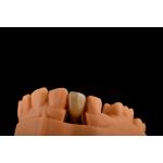 Internal Hex 3.0mm Depth 1.5mm Pitch Single Titanium Tooth Implant Replacement