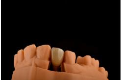 China Internal Hex 3.0mm Depth 1.5mm Pitch Single Titanium Tooth Implant Replacement supplier
