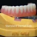 Titanium Implant Supported Dentures Precise Ivoclar Denture Over Implants ISO FDA CE for sale