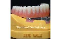 China Titanium Implant Supported Dentures Precise Ivoclar Denture Over Implants ISO FDA CE supplier