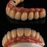 Casting And Milling PFM Tooth Crown , Dental Restorations Porcelain Fused Metal Crown for sale