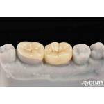 Emax Inlay Onlay Precise Fit And Hypoallergenic Biocompatibility Easy To Clean