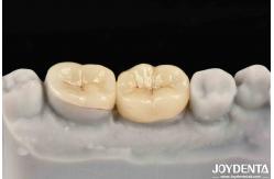 China Emax Inlay Onlay Precise Fit And Hypoallergenic Biocompatibility Easy To Clean supplier