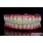 Lightweight Dental Titanium Malong Hybrid Bridge Comfortable For Dental Restoration for sale
