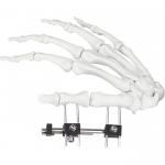 Orthopedic Surgical Mini Fragment Ilizarov External Fixation Device