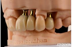China Precision Dental Implant Crown and Bridge Perfect Solution for Aesthetically Pleasing Smile supplier