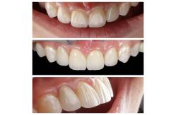 China Anterior Tooth Indication Dental Veneers With 0.5mm Thickness And Perfect Permeability supplier