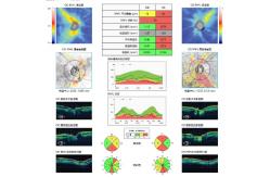 China OCT Optical Coherence Tomography Machine Posterior Segment supplier