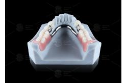 China CE FDA Ball Attachment Dentures Comfortable Denture Ball Attachment Long Lasting supplier