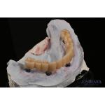 Dental Restorations Multiple Teeth Implant Endosseous Replace Two Front Teeth for sale